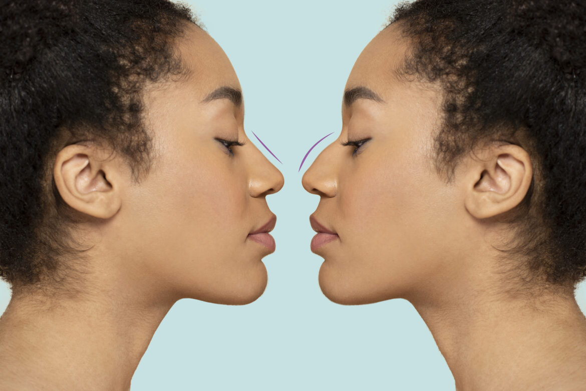 Choisir entre une rhinoplastie chirurgicale  et une rhinoplastie médicale ?