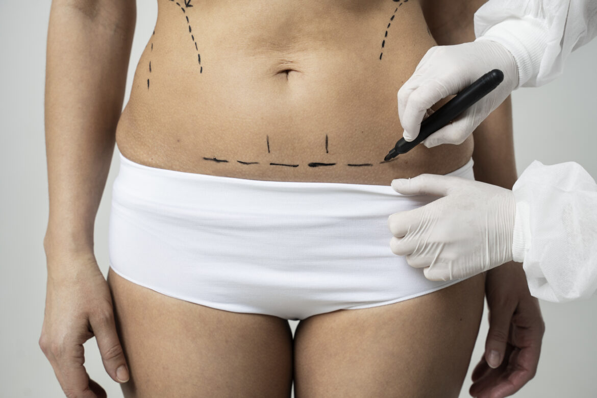Choisir entre une abdominoplastie et une liposuccion